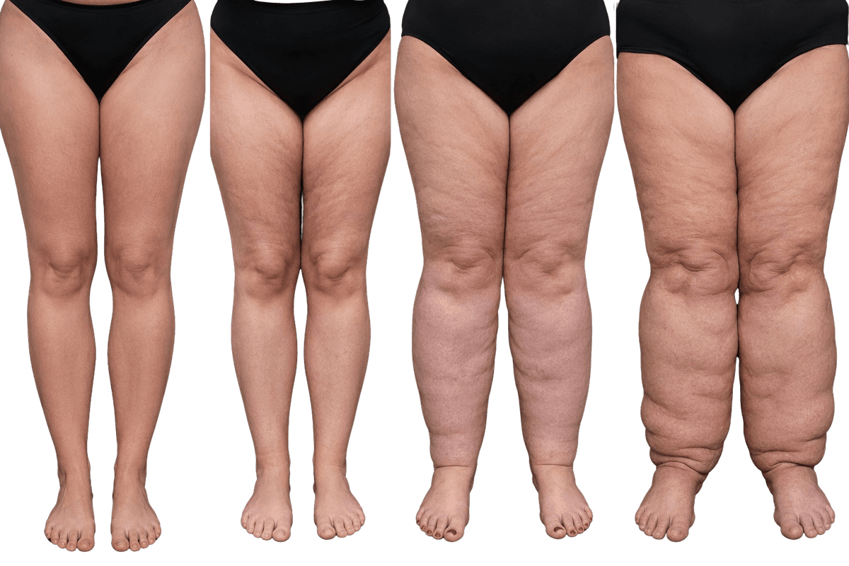 Stages of lipedema: disproportion between trunk and limbs, not simple excess weight.