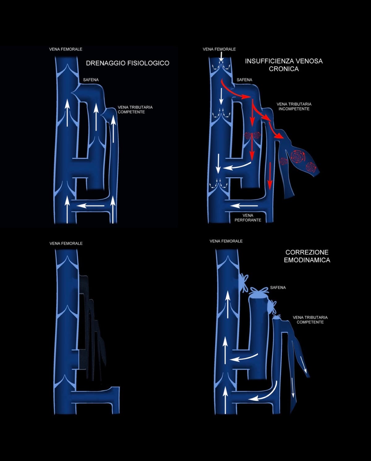 From physiological drainage to reflux, through to haemodynamic correction.