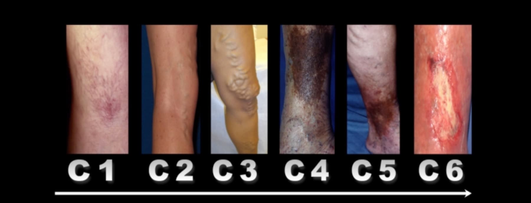 The six stages of chronic venous disease (CEAP classification)