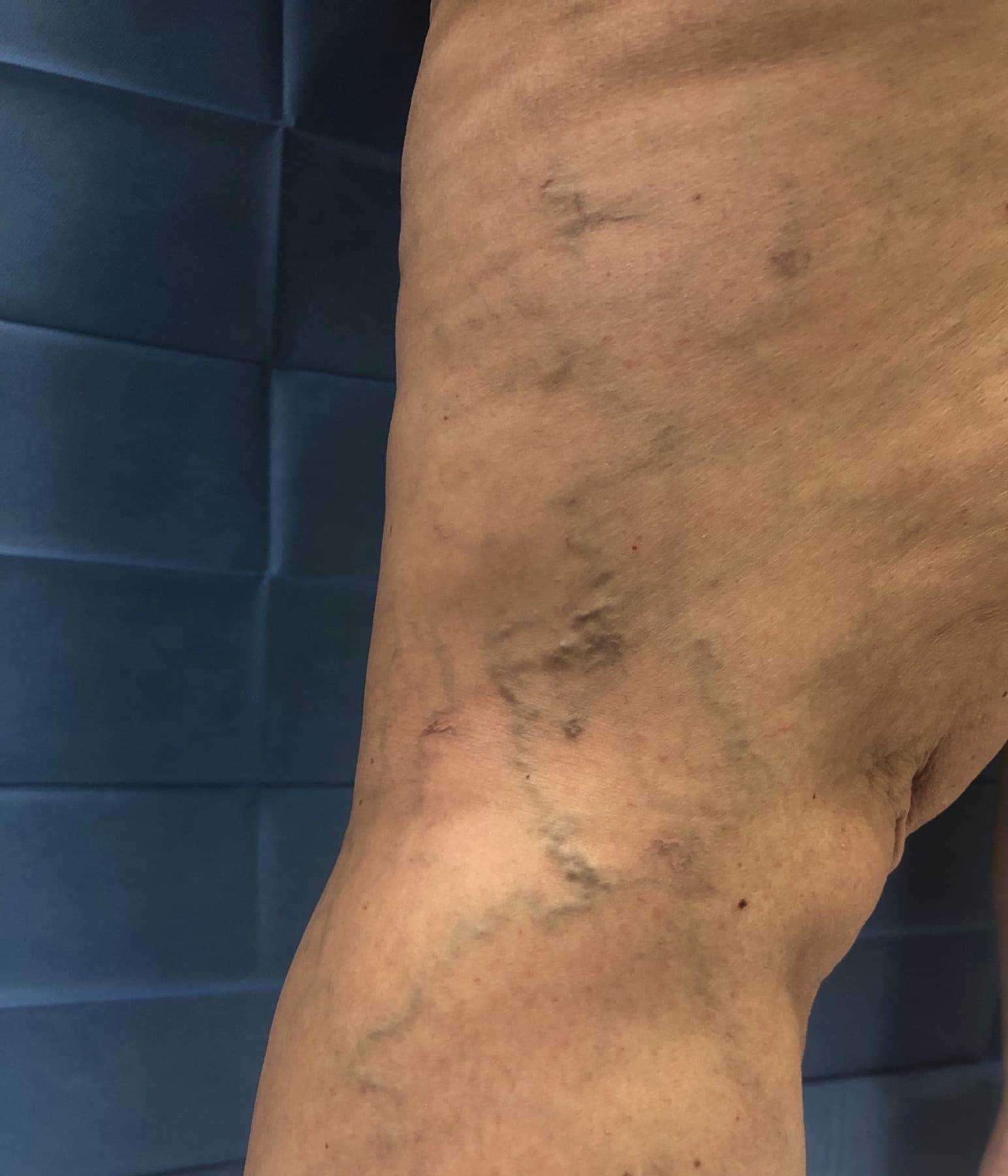 Varicose veins: dilatation of the larger vessels