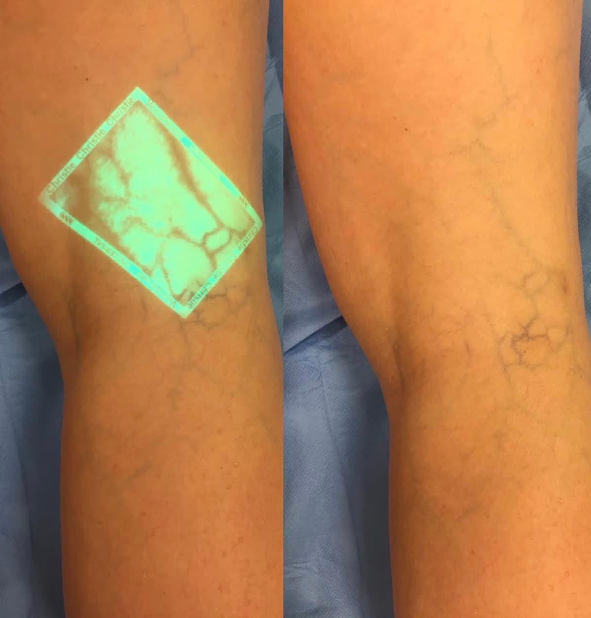 Spider veins assessed with an augmented-reality visualiser.